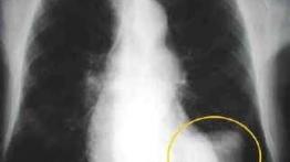 Zanieczyszczenia miast a nasze zdrowie